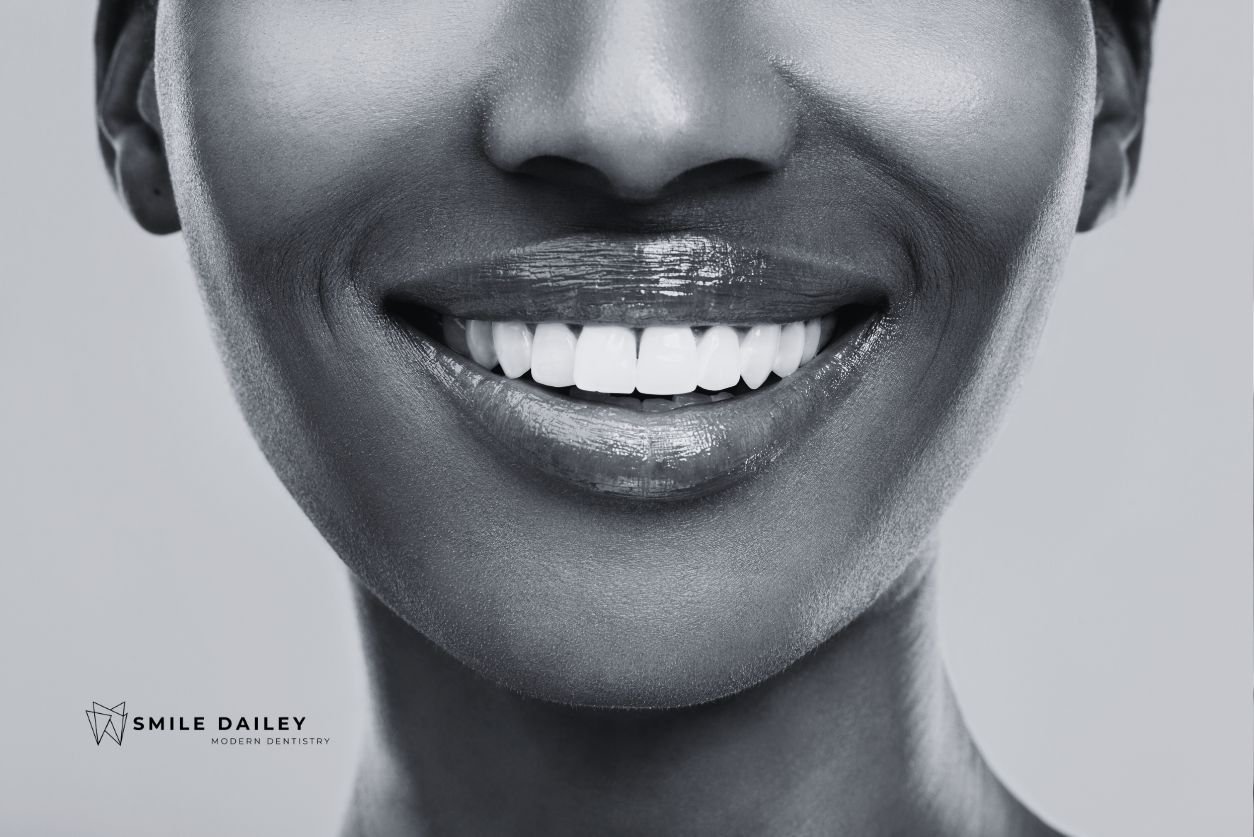 Veneers Lifespan: How Long Do They Really Last? cover