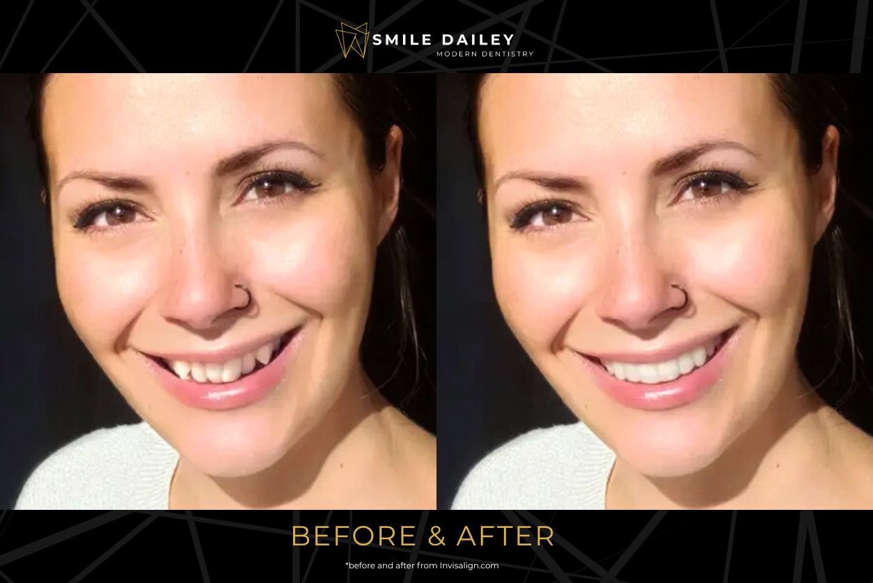 Invisalign Before and After: What Changes Can You Expect cover